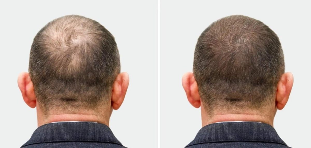 Why Hair Replacement Treatments Are Becoming More Popular Today