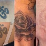 tattoo removal