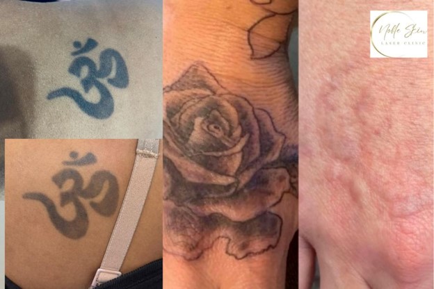 tattoo removal